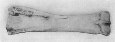 Fig. 16—Posterior view of radius (right) illustrative of
effects of splint. Note the extent of exostosis. Fig. 16—Posterior view of radius (right) illustrative of
effects of splint. Note the extent of exostosis.