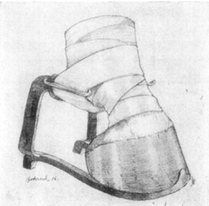 Fig. 28—Showing the Roberts brace in operation. Fig. 28—Showing the Roberts brace in operation.