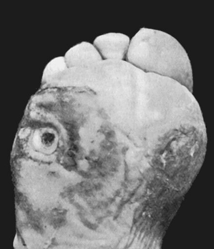 Fig. 15.&mdash;Perforating Ulcers of Sole of Foot. (From Photograph lent by Sir Montagu Cotterill.)