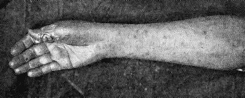 Fig. 38.&mdash;Primary Lesion on Thumb, with Secondary Eruption on Forearm.