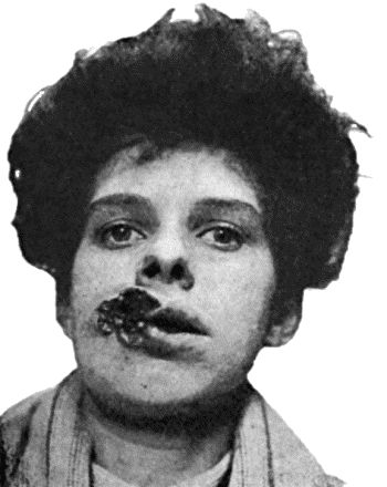 Fig. 40.&mdash;Ulcerating Gumma of Lips.  (From a photograph lent by Dr. Stopford Taylor and Dr. R.W. Mackenna.)