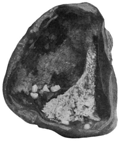 Fig. 59.&mdash;Dermoid Cyst of Ovary showing Teeth in its interior.