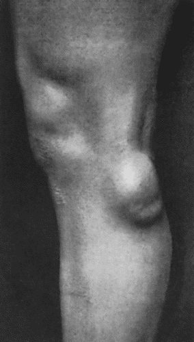 Fig. 61.&mdash;Ganglion on lateral aspect of Knee in a young woman.