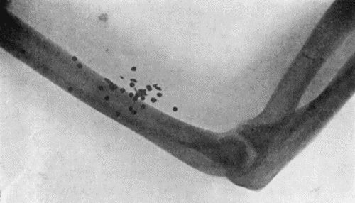 Fig. 62.&mdash;Radiogram showing Pellets embedded in Arm. (Mr. J.W. Dowden's case.)