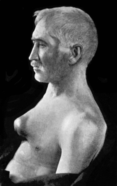 Fig. 74.&mdash;Thoracic Aneurysm, threatening to rupture externally, but prevented from doing so by Macewen's needling. The needles were left in for forty-eight hours.