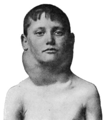Fig. 80.&mdash;Chronic Hodgkin's Disease in a boy &aelig;t.&nbsp;11.