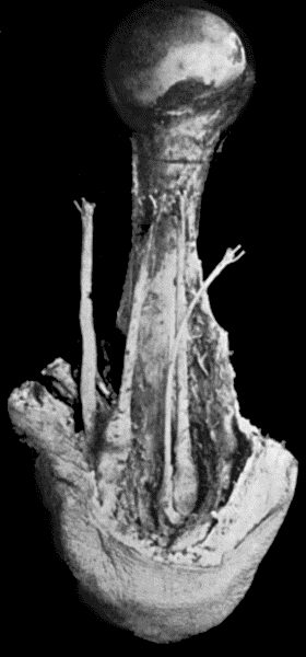 Fig. 85.&mdash;Amputation Stump of Upper Arm, showing bulbous thickening of the ends of the nerves, embedded in scar tissue at the apex of the stamp.