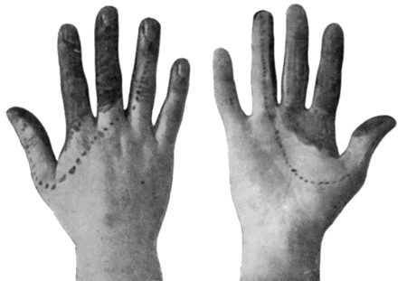 Fig. 91.&mdash;To illustrate the Loss of Sensation produced by Division of the Median Nerve. The area of complete cutaneous insensibility is shaded black. The parts insensitive to light touch and to intermediate degrees of temperature are enclosed within the dotted line. (After Head and Sherren.)