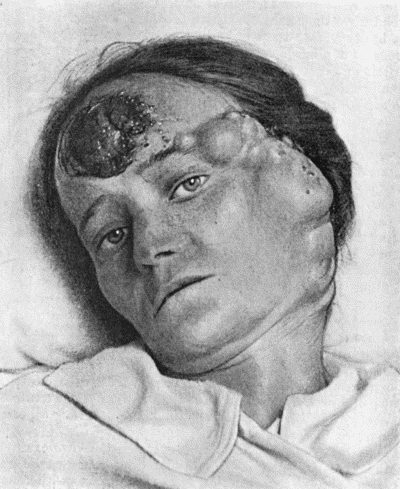 Fig. 105.&mdash;Melanotic Cancer of Forehead with Metastases in Lymph Vessels and Glands.