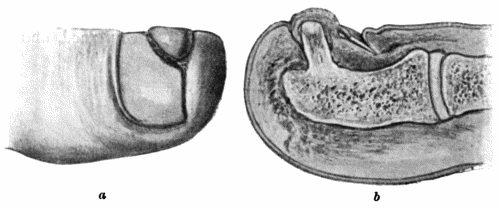 Fig. 107.&mdash;Subungual Exostosis growing from Distal Phalanx of Great Toe, showing Ulceration of Skin and Displacement of Nail. a. Surface view. b. On section.