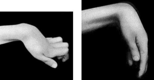Fig. 109.&mdash;Volkmann's Isch&aelig;mic Contracture. When the wrist is flexed to a right angle it is possible to extend the fingers. (Photographs lent by Mr. Lawford Knaggs)