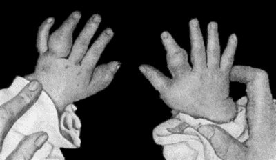 Fig. 128.&mdash;Tuberculous Dactylitis.