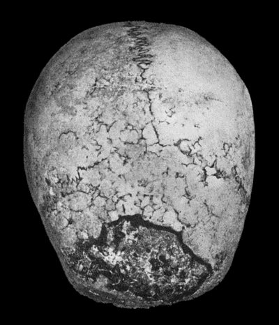 Fig. 130.&mdash;Syphilitic Disease of Skull, showing a sequestrum in process of separation.