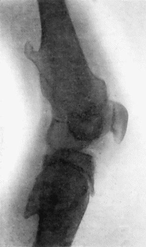 Fig. 138.&mdash;Radiogram of Right Knee showing Multiple Exostoses.