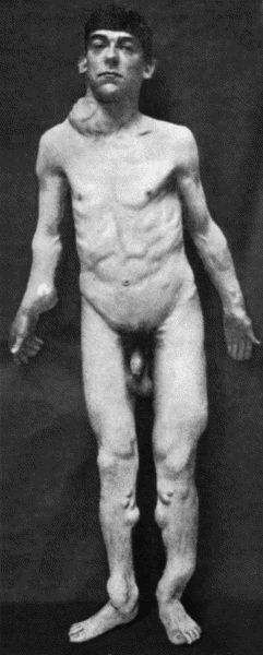 Fig. 140.&mdash;Multiple Cartilaginous Exostoses in a man &aelig;t.&nbsp;27. The scapular tumour projecting above the right clavicle has taken on active growth and pressed injuriously on the cords of the brachial plexus.