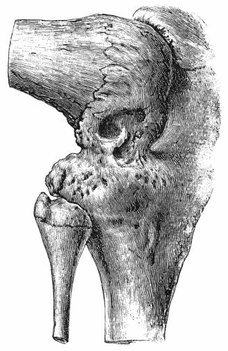Fig. 155.&mdash;Osseous Ankylosis of Knee in the flexed position following upon Tuberculous Arthritis. (Anatomical Museum, University of Edinburgh.)