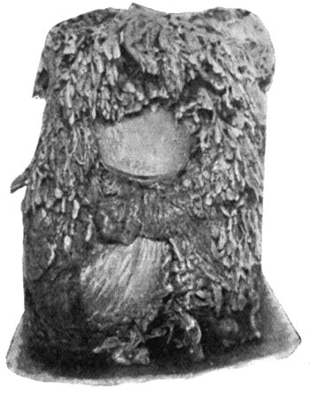 Fig. 159.&mdash;Hypertrophied Fringes of Synovial Membrane in Arthritis Deformans of Knee.  (Museum of Royal College of Surgeons, Edinburgh.)