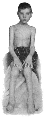 Fig. 161.&mdash;Arthritis Deformans affecting several Joints, in a boy &aelig;t.&nbsp;10.  (Dr. Dickson's case.)