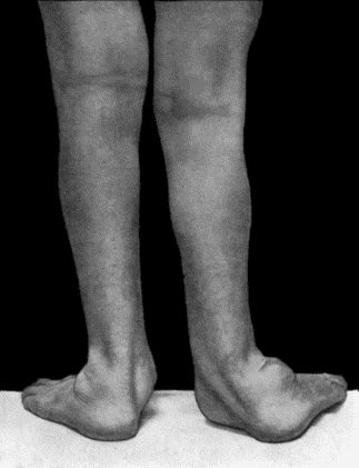 Fig. 165.&mdash;Charcot's Disease of both Ankles: back view. Man, &aelig;t.&nbsp;32.